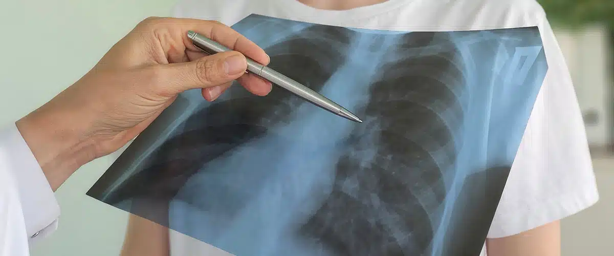 Mutuelle pneumologue